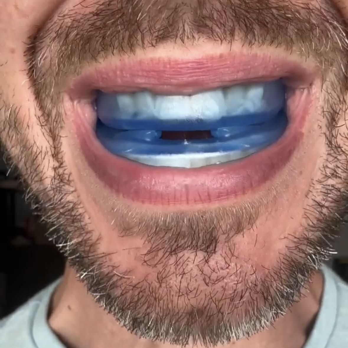 Honex The Quiet Anti-Snoring Mouthpiece Universal Size